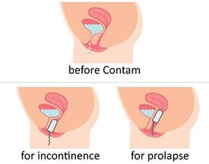Contam Duo Vaginal Pessary 1