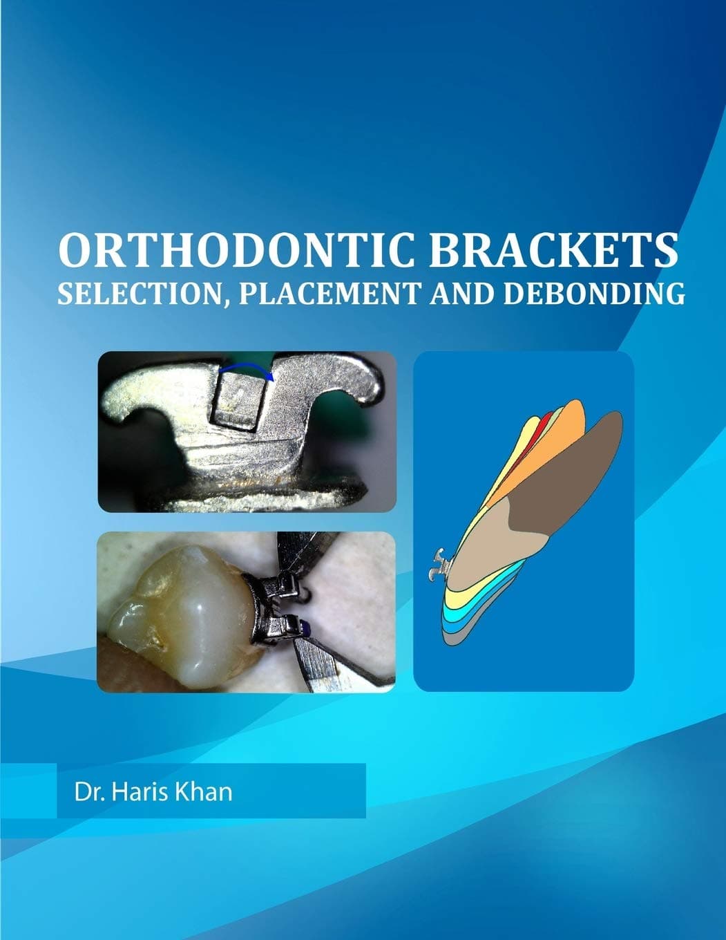 Orthodontic Brackets: Selection,Placement and Debonding Paperback – March 18, 2015
